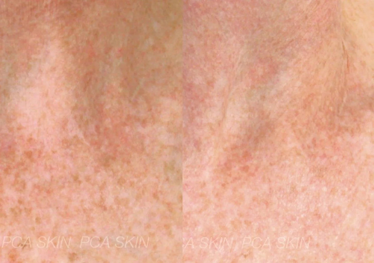 PCA Skin Brightening Bar® fades hyperpigmentation and dark spots for a more radiant complexion.