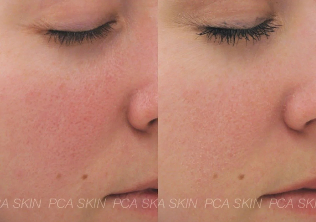 PCA Skin Dual Action Redness Relief instantly soothes sensitive and irritated skin with bisabolol and InflaShield™.