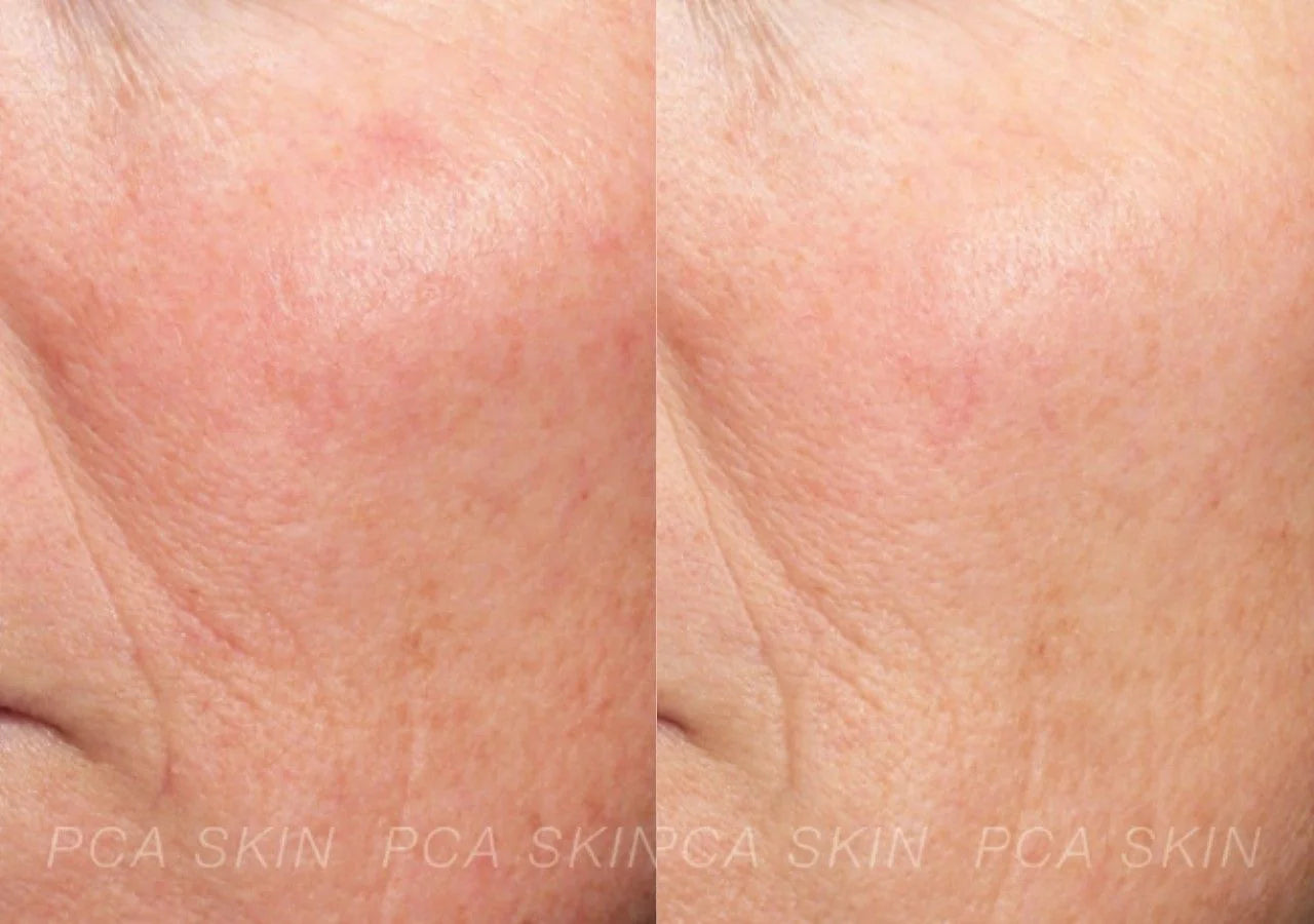 PCA Skin Resveratrol Restorative Complex reduces redness, soothes irritation, and hydrates skin.