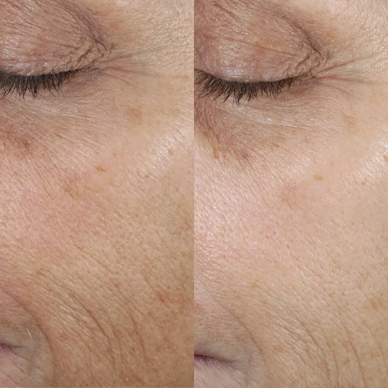 Skinbetter Science Even Tone Correcting Serum helps fade dark spots and hyperpigmentation, promoting a brighter, more even complexion.