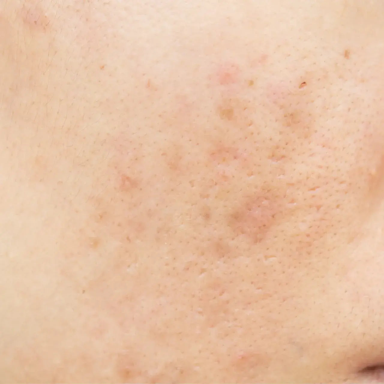 DermaQuest SkinBrite Serum visibly fading dark spots and hyperpigmentation.