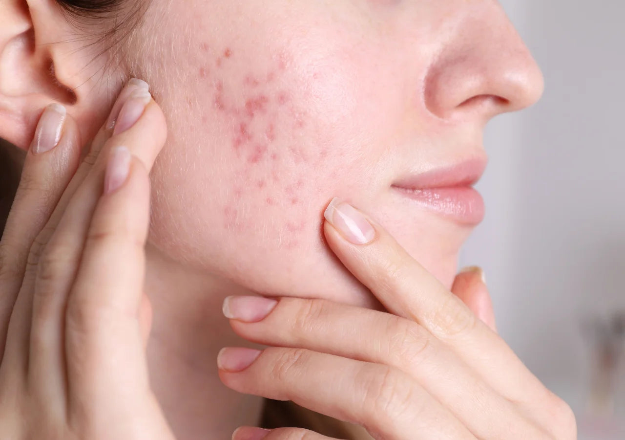 GlyMed Plus Tri-Acid 15% Skin Gel clears acne effectively, targeting breakouts and preventing future blemishes.