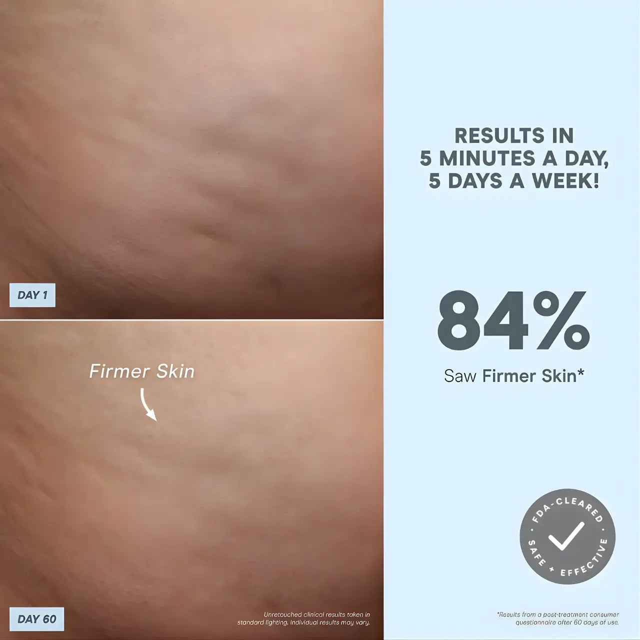 NuFACE NuBODY Microcurrent Skin Toning Device for Firming and Smoothing Body Skin Results in 5 Minutes a Day