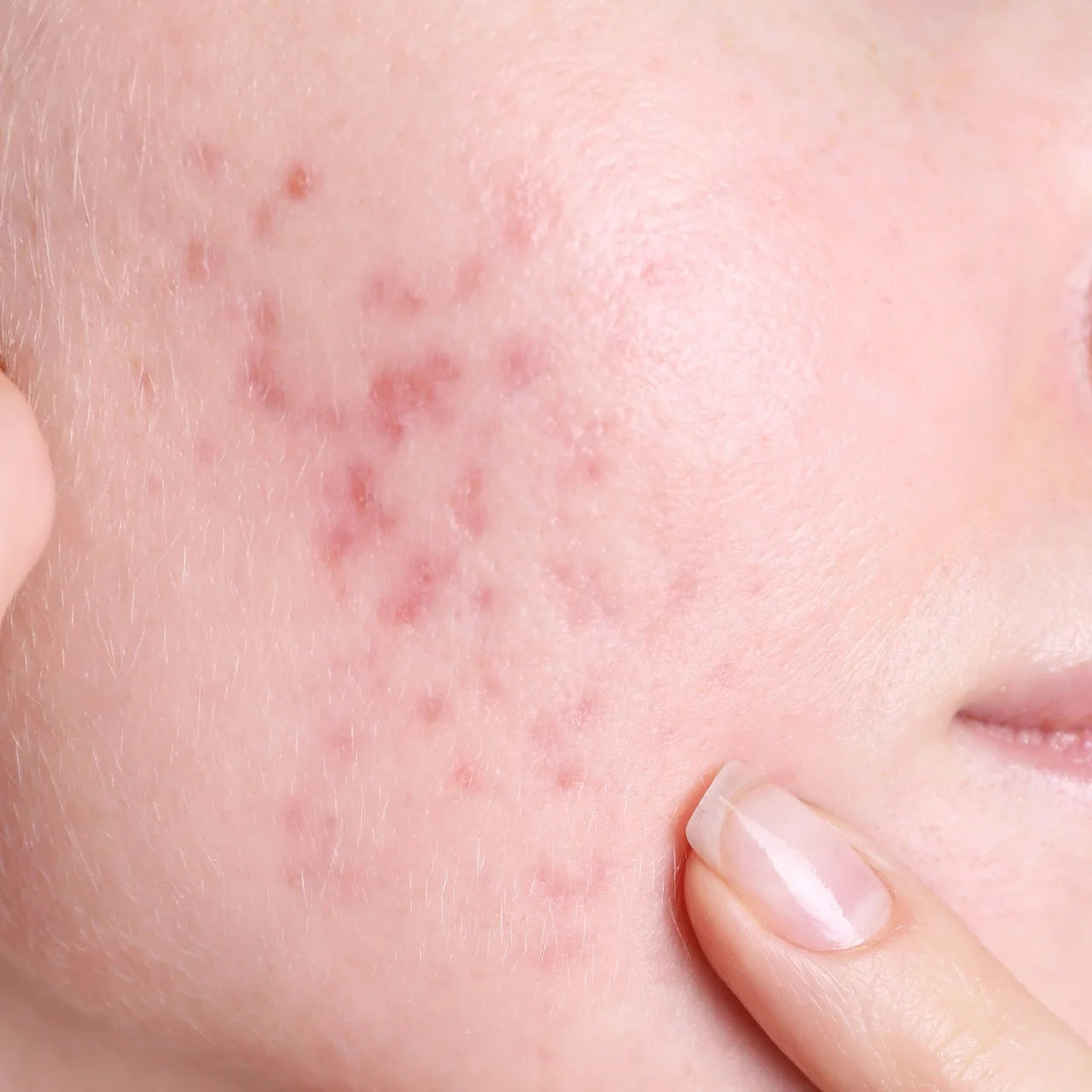 Osmosis Catalyst MD Advanced serum – helps reduce redness and fade scars for smoother, healthier-looking skin.