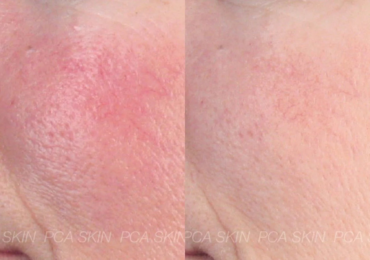 PCA Skin Anti-Redness Serum instantly calms and reduces redness for sensitive skin.