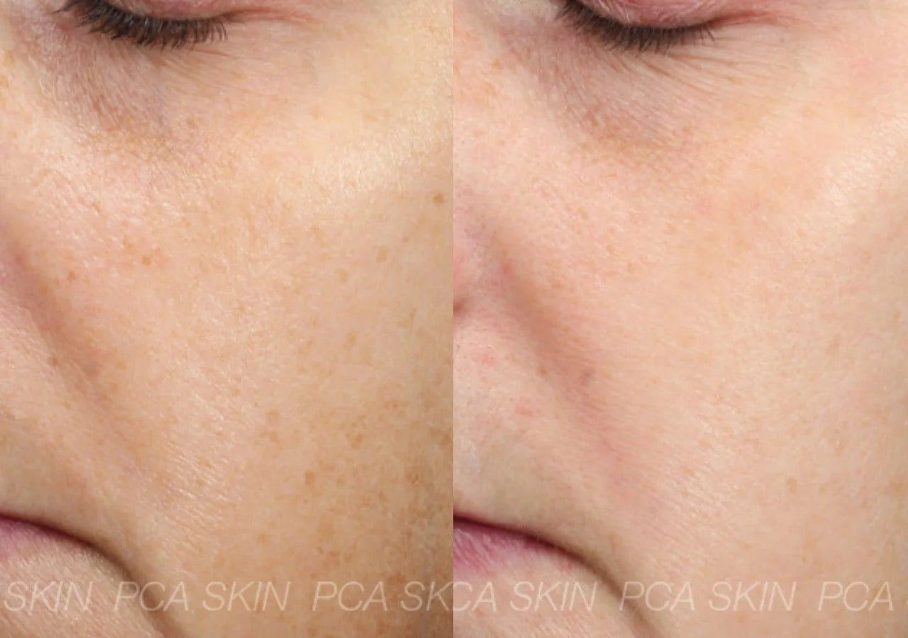 PCA Skin Vitamin B3 Brightening Serum reduces dark spots and evens skin tone with Niacinamide and peptides.
