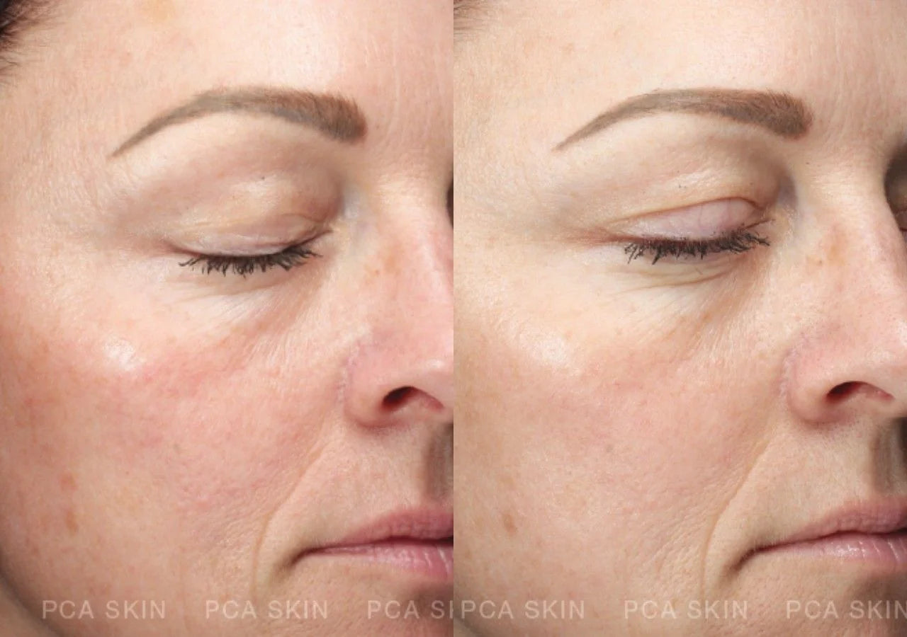 PCA Skin C&E Advanced fades dark spots and hyperpigmentation with Hexylresorcinol & Vitamin C