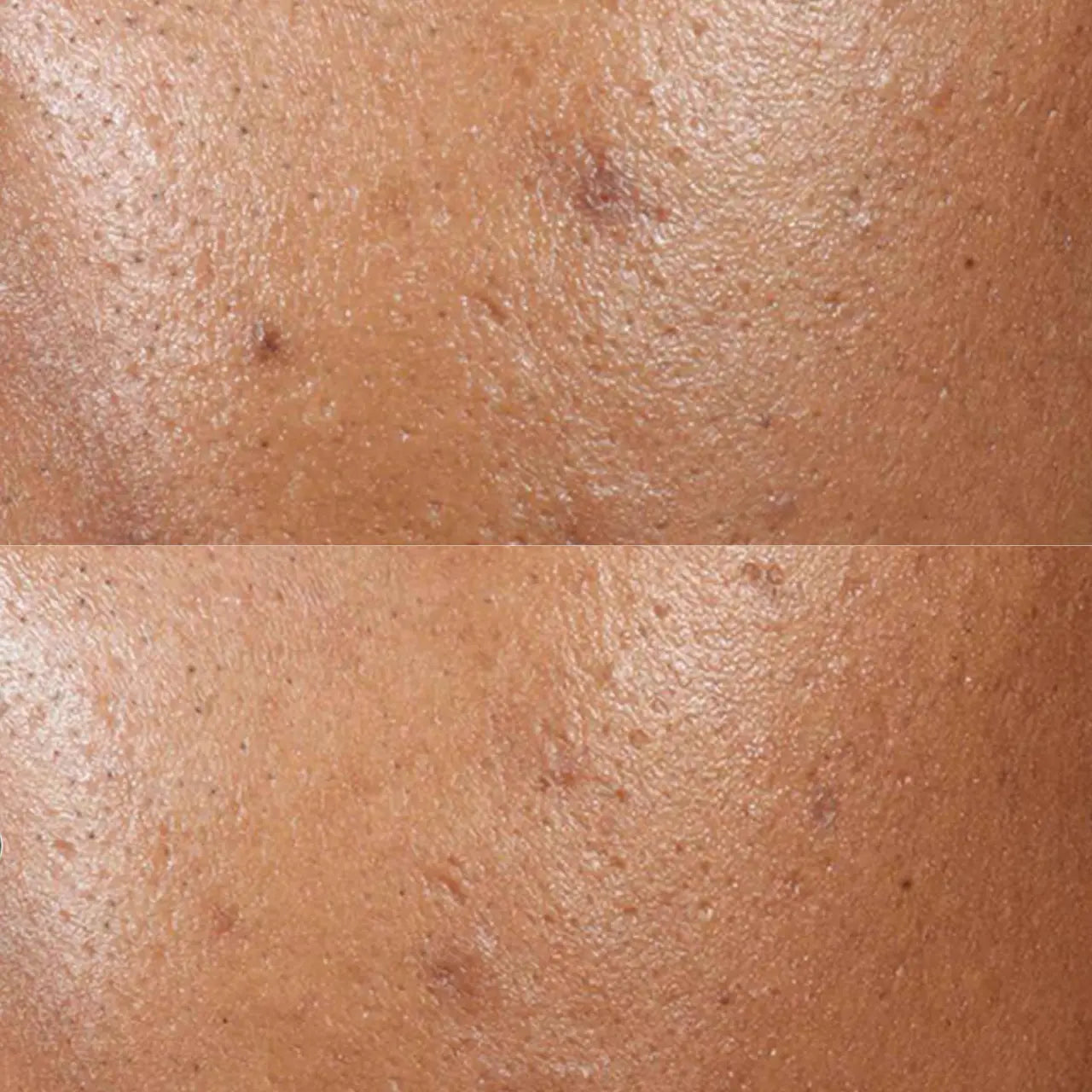 SkinCeuticals Phyto A+ Brightening Treatment improves skin clarity, fades post-blemish marks, and enhances radiance with azelaic acid and alpha arbutin.