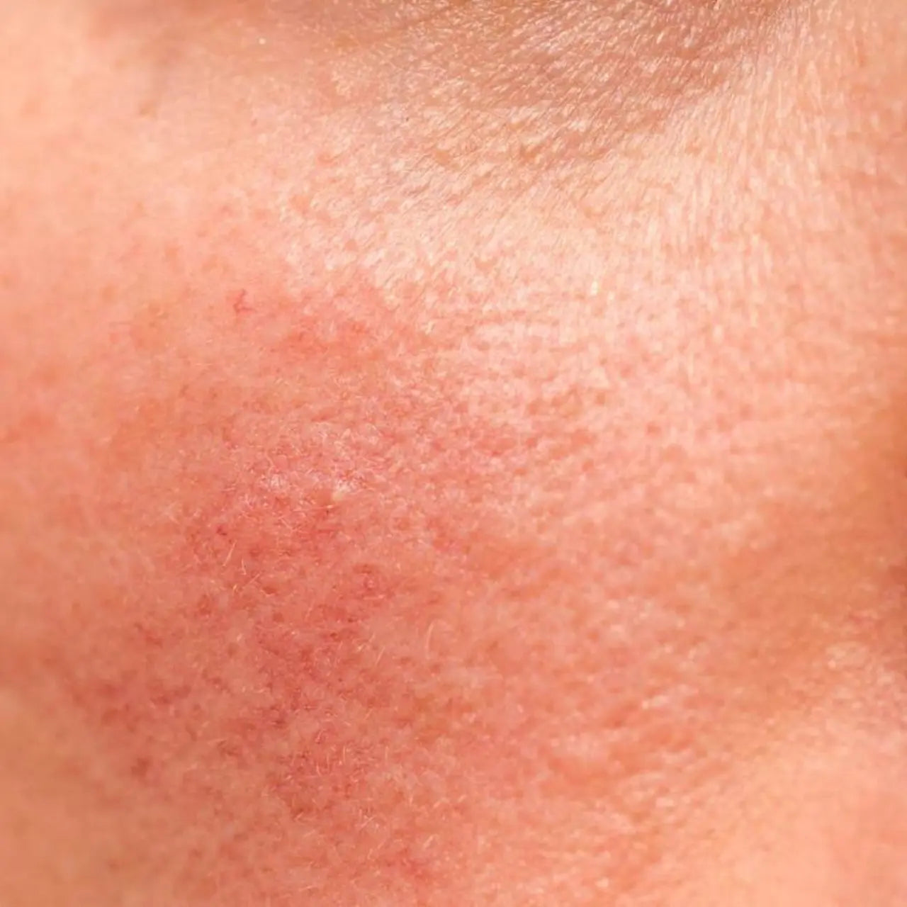 SkinCeuticals Phyto Corrective Essence Mist instantly soothes and reduces visible redness for a calm, even-toned complexion.