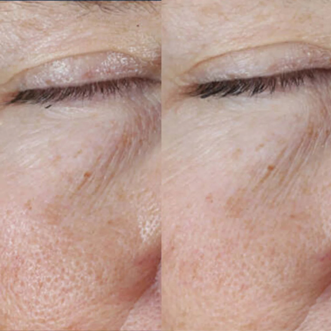 Skinbetter Science Instant Effect Gel EYE smooths and softens the delicate eye area with antioxidants and hydrating ingredients for a refreshed look.