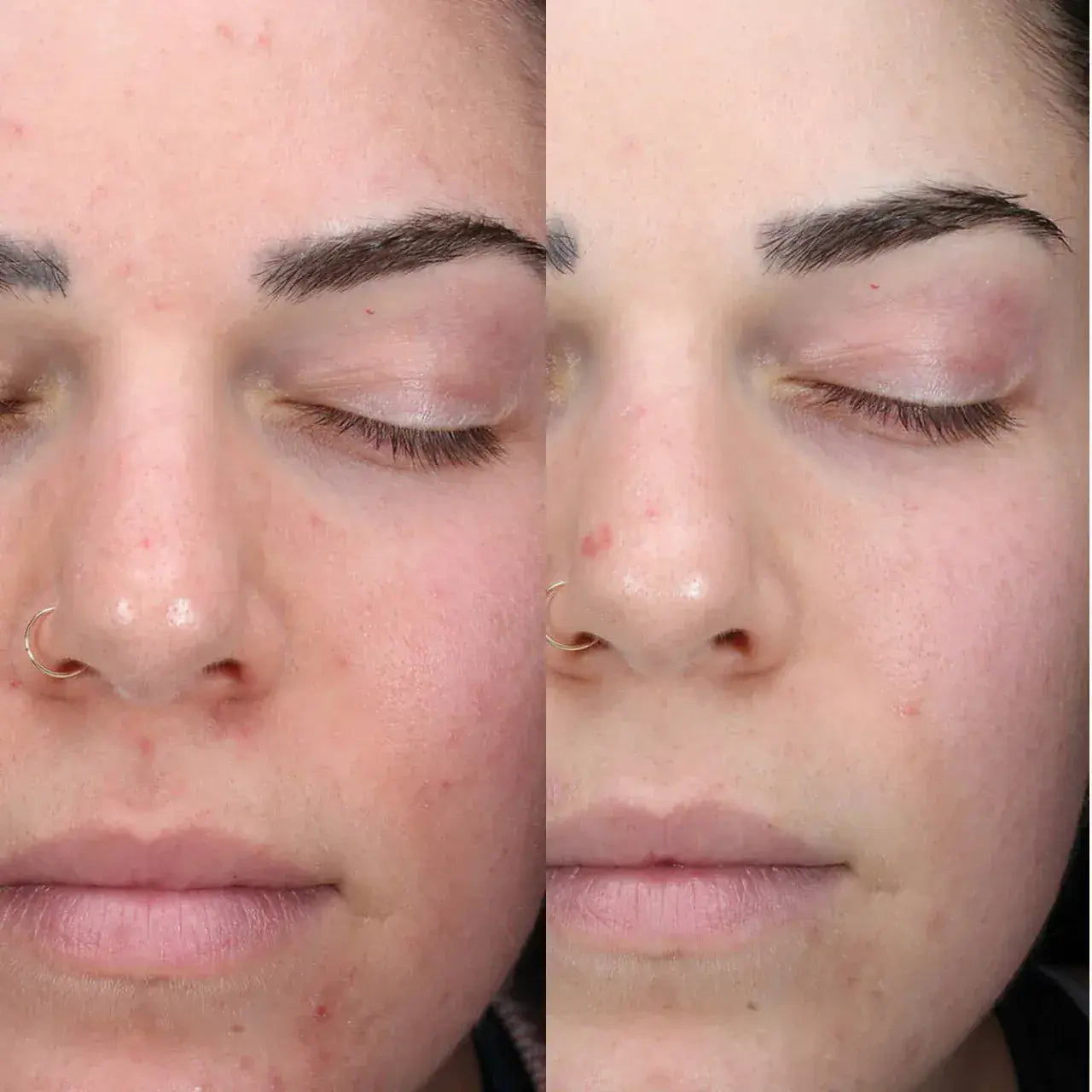 Skinbetter Science AlphaRet® Clearing Serum helps clear pores, reduce oiliness, and minimize breakouts for a smoother, more refined complexion.