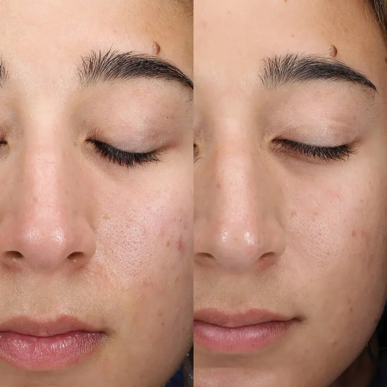 Skinbetter Science AlphaRet® Clearing Serum exfoliates and smooths rough skin texture with AlphaRet®, salicylic acid, and lactic acid.