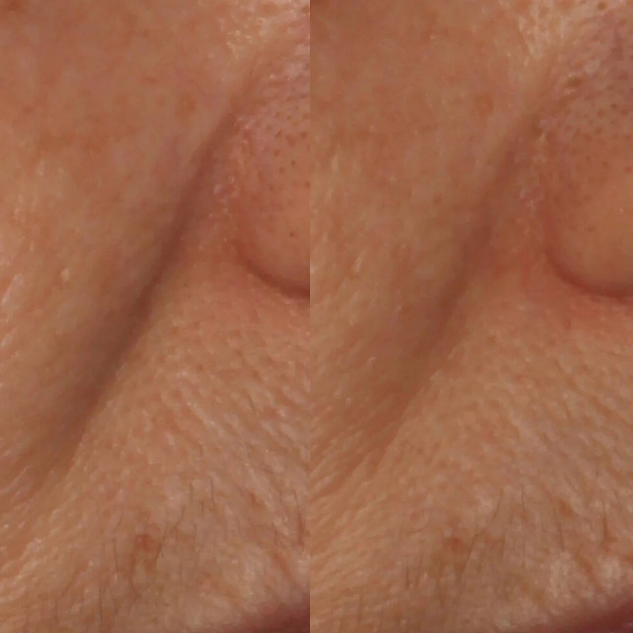 Skinbetter Science® InterFuse® Intensive Treatment LINES enhances collagen production with peptides, improving skin elasticity and reducing wrinkles.