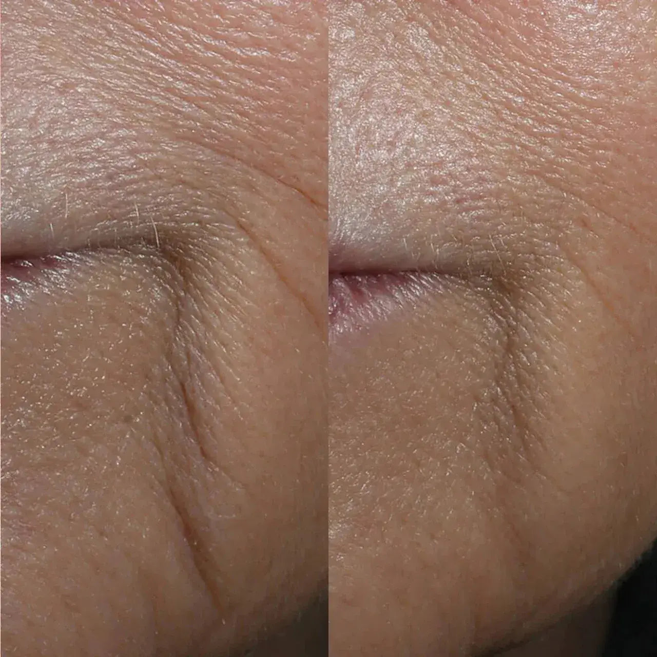 Skinbetter Science® InterFuse® Intensive Treatment LINES helps reduce deep wrinkles and fine lines with advanced peptides and InterFuse® technology.