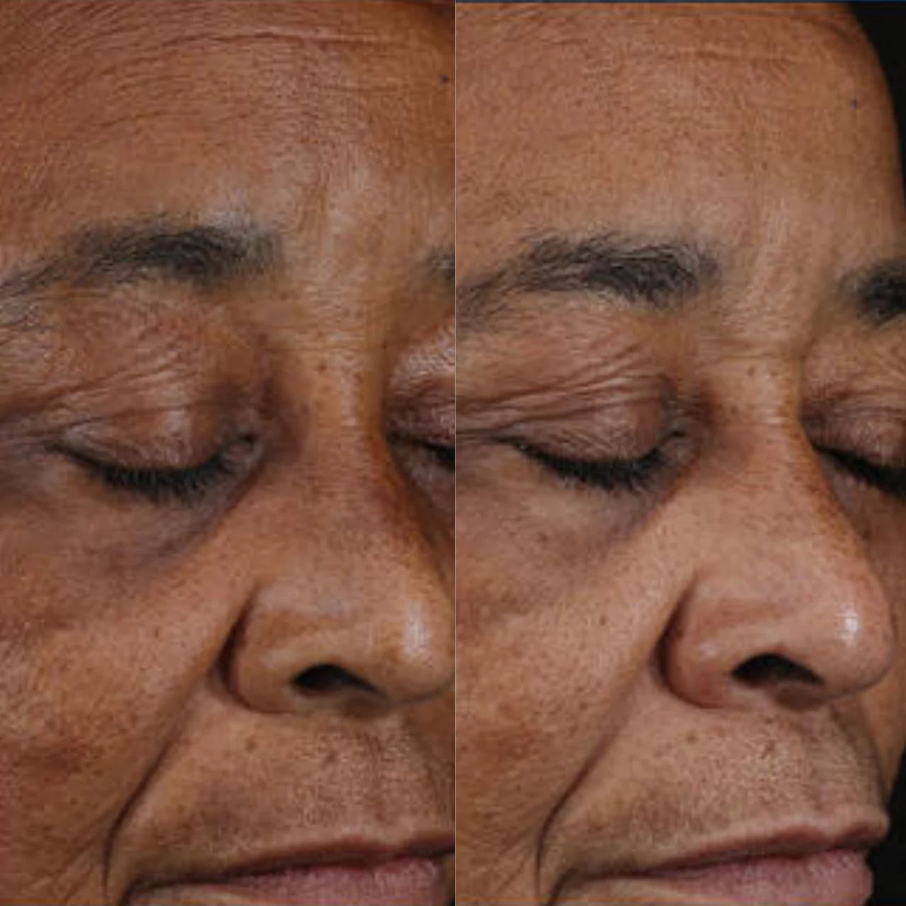 Skinbetter Science® Mystro™ Active Balance Serum smooths rough skin, minimizes pores, and enhances skin clarity for a more even, refined texture.