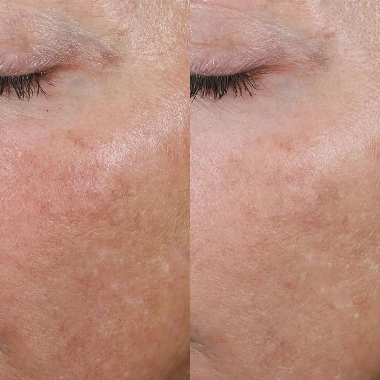 Skinbetter Science® Skin Quality Duo calms redness, minimizes pores, and balances skin tone.