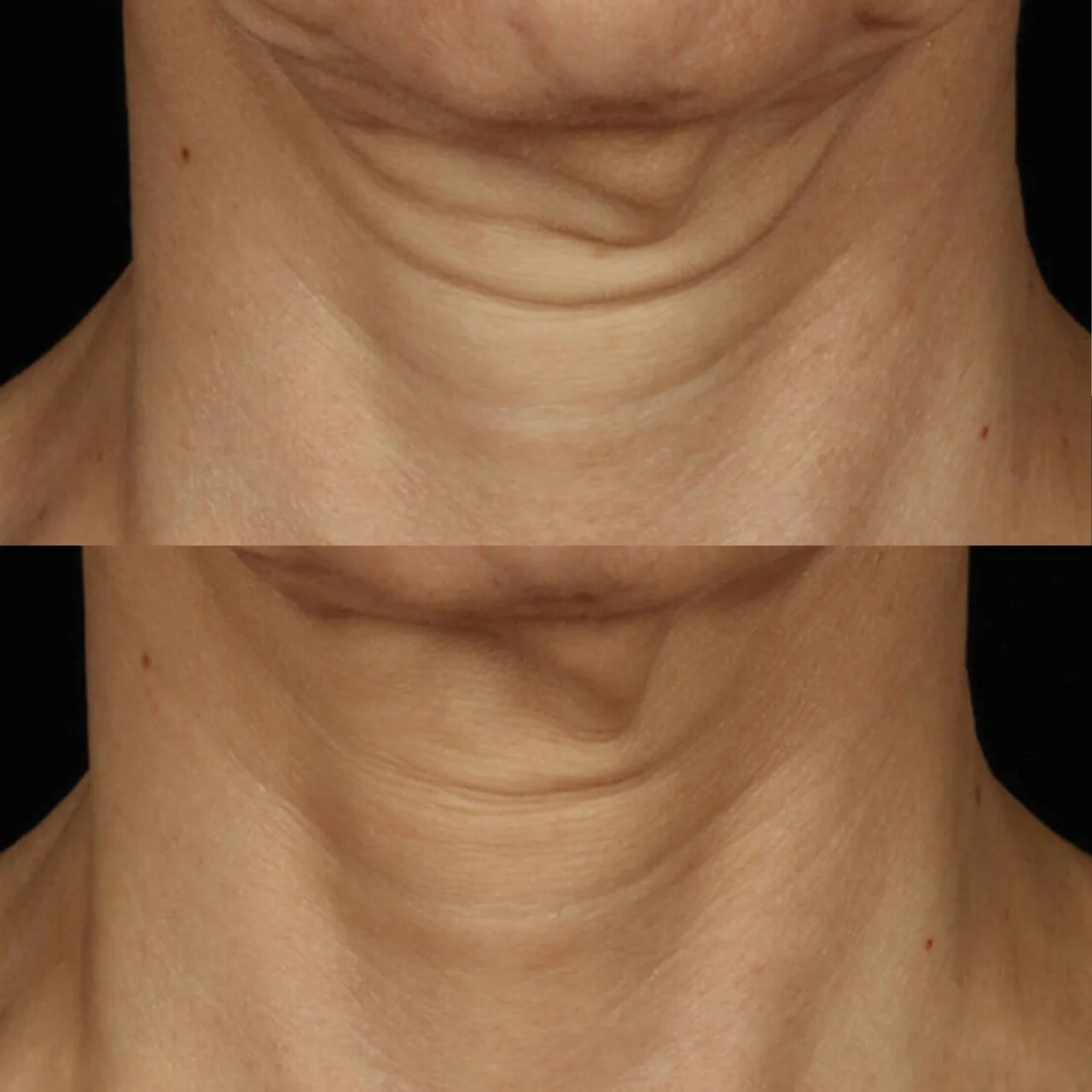 SkinCeuticals Tripeptide-R Neck Repair visibly firms and lifts the neck, improving elasticity and reducing sagging over time.
