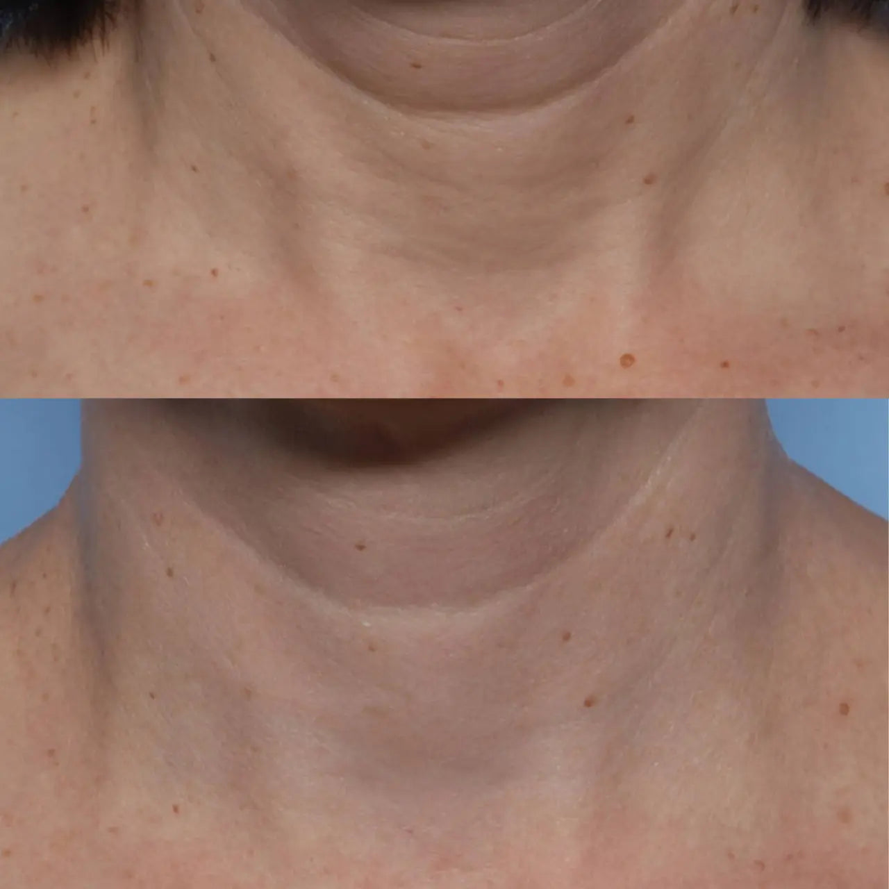 Skinbetter Science® Techno™ Neck Perfecting Cream helps firm and lift sagging skin on the neck and décolleté for a more youthful appearance.