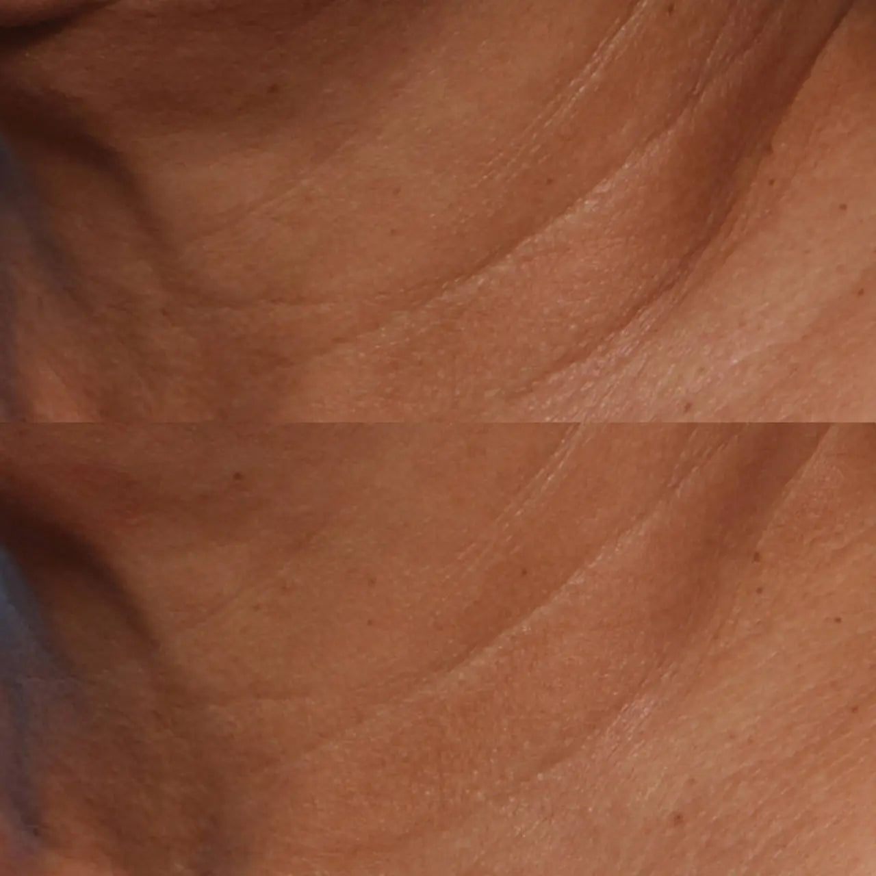 Skinbetter Science® Techno™ Neck Perfecting Cream smooths rough texture and refines skin tone for a softer, more radiant look.