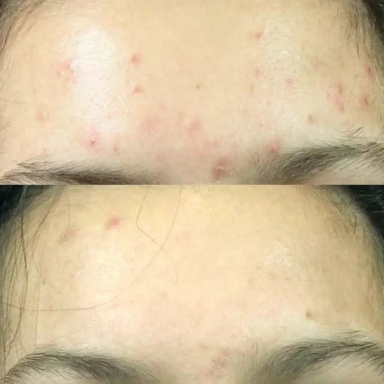 Vivier® Acne Treatment Lotion with 5% Benzoyl Peroxide helps clear and prevent acne by eliminating bacteria and reducing breakouts.