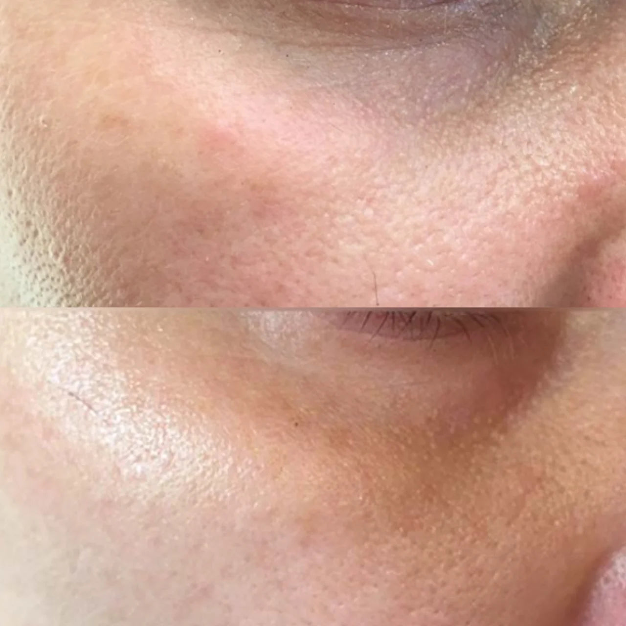 Vivier® GrenzCine® Eye firms and lifts the skin around the eyes, reducing sagging and providing a smoother, youthful look.