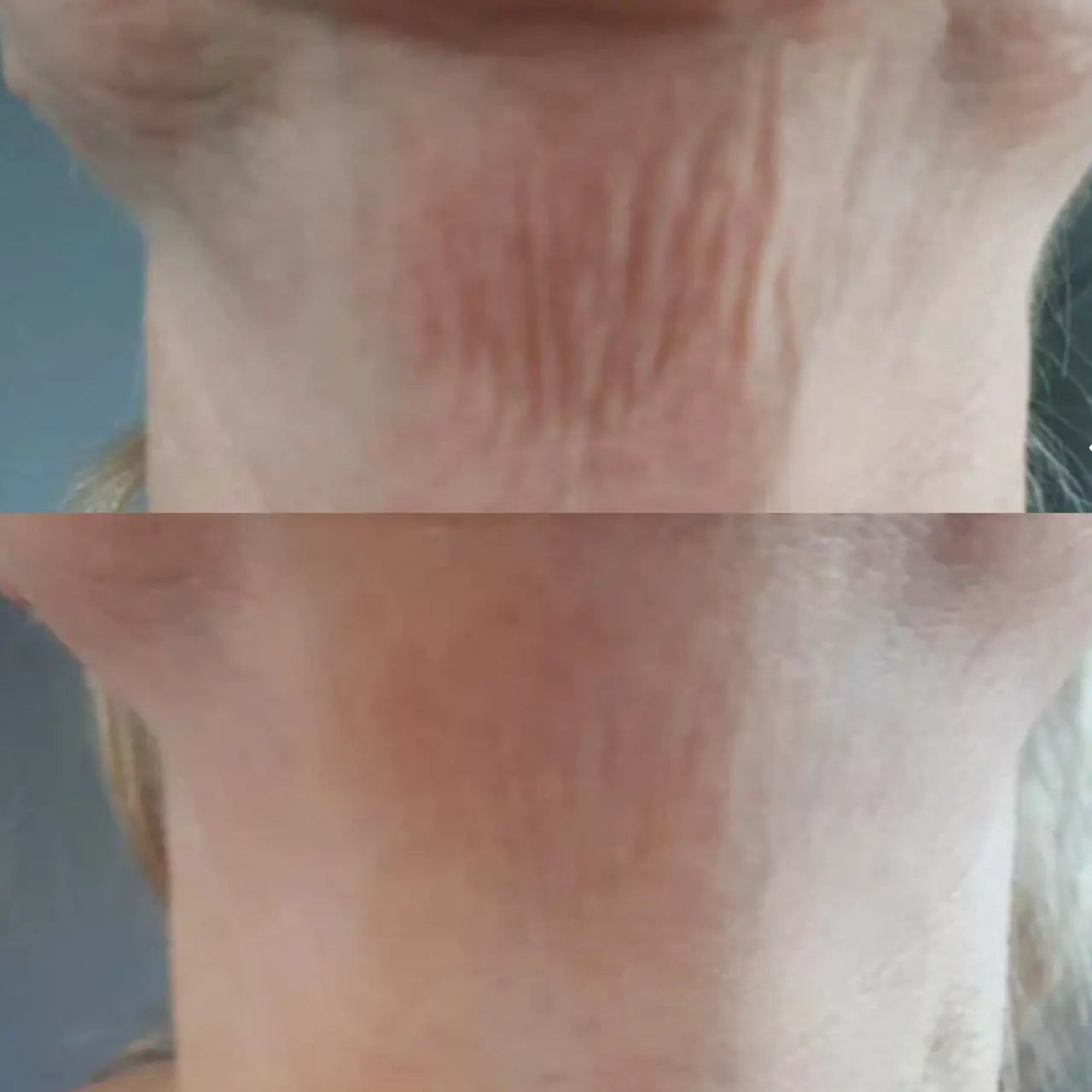 Vivier® GrenzCine Neck cream visibly firms and lifts sagging skin for a youthful, sculpted neckline.