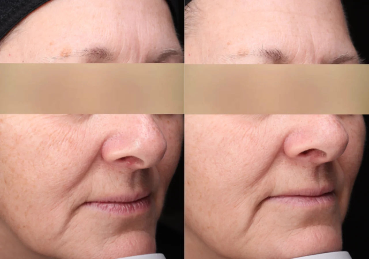 Retinol 1.0% and AHA exfoliants refine texture, smooth wrinkles, and enhance collagen.