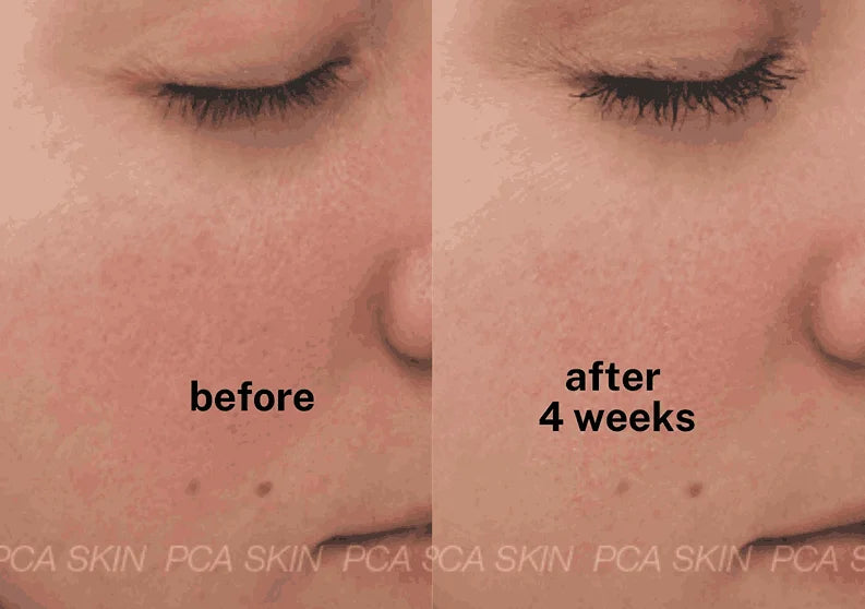 PCA Skin Dual Action Redness Relief instantly soothes sensitive and irritated skin with bisabolol and InflaShield™.