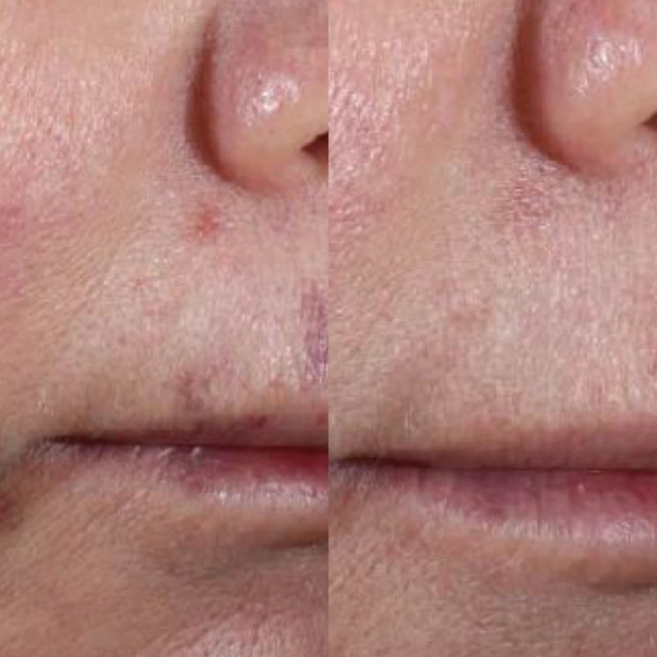 Alastin INhance Serum with TriHex and ChromaFADE Technology speeds recovery, reduces redness, and minimizes swelling post-injection.
