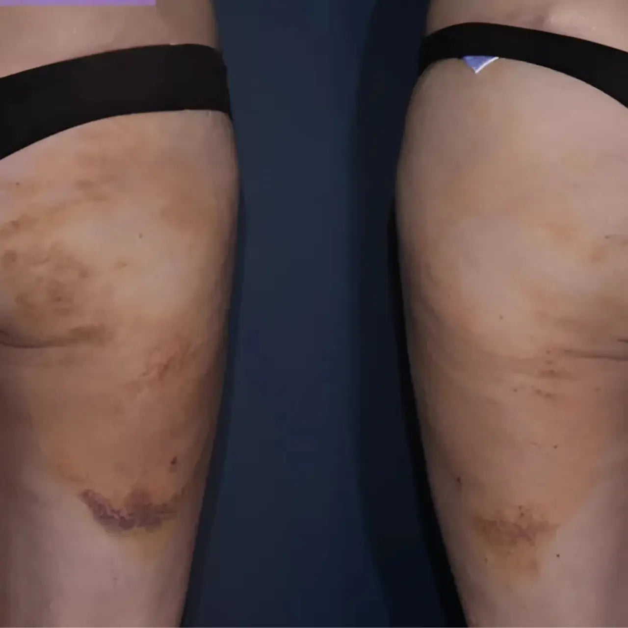 Accelerated healing with Alastin ReFORM & RePAIR COMPLEX, helping skin recover faster after cosmetic procedures and reduce downtime.