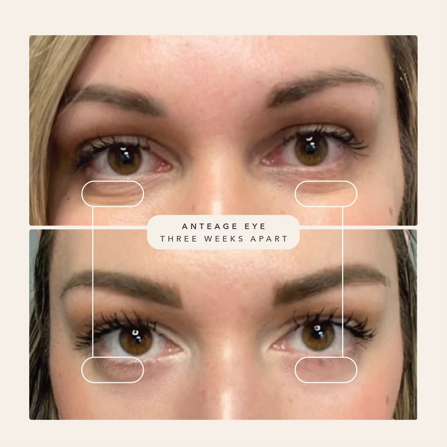 Before and after comparison of a woman's eyes after three weeks of using AnteAGE eye cream, showing visible improvement in skin texture and reduced puffiness.