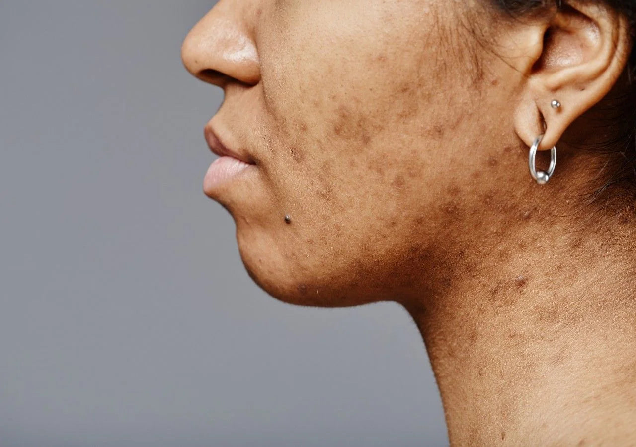 Acne spot treatment with 2% Salicylic Acid to reduce blemishes and prevent future breakouts.