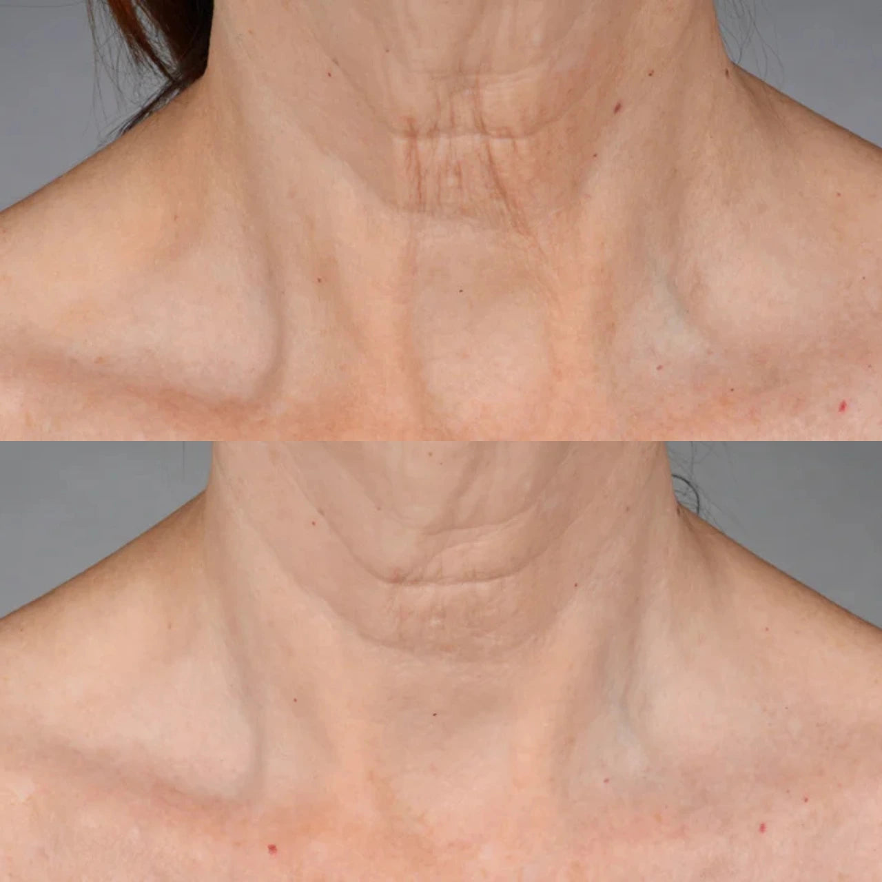 Firmness and Lift Boost - Skin Tightening and Sculpting for Neck and Jawline.