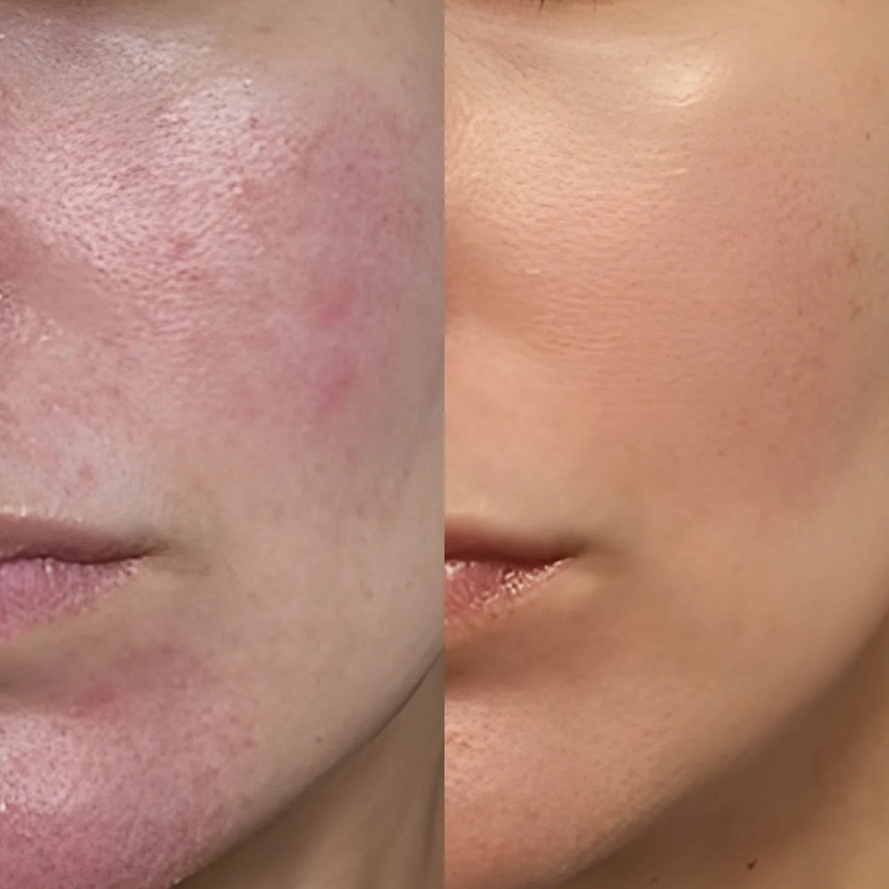 Osmosis Catalyst MD Advanced serum – helps reduce redness and fade scars for smoother, healthier-looking skin.