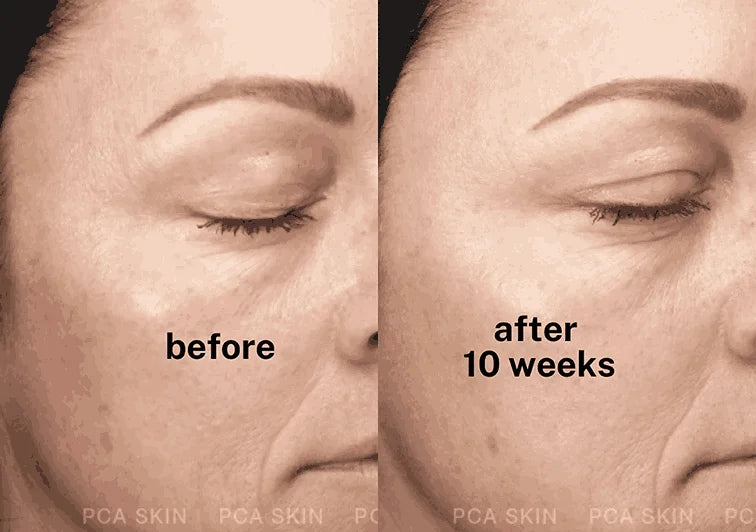 PCA Skin C&E Advanced fades dark spots and hyperpigmentation with Hexylresorcinol & Vitamin C