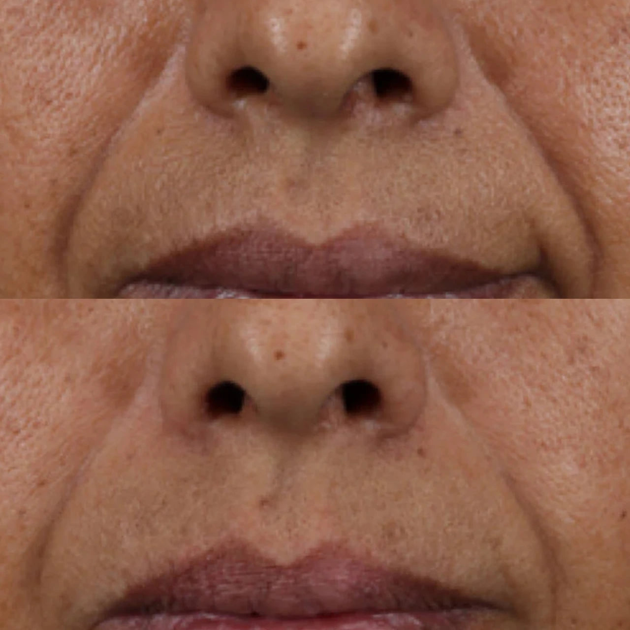 SkinCeuticals HA Intensifier Multi-Glycan visibly reduces fine lines and wrinkles, enhancing skin firmness and restoring youthful volume.