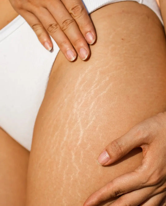 stretch marks