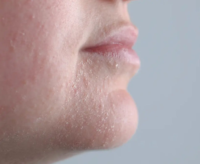 very dry skin type dryness