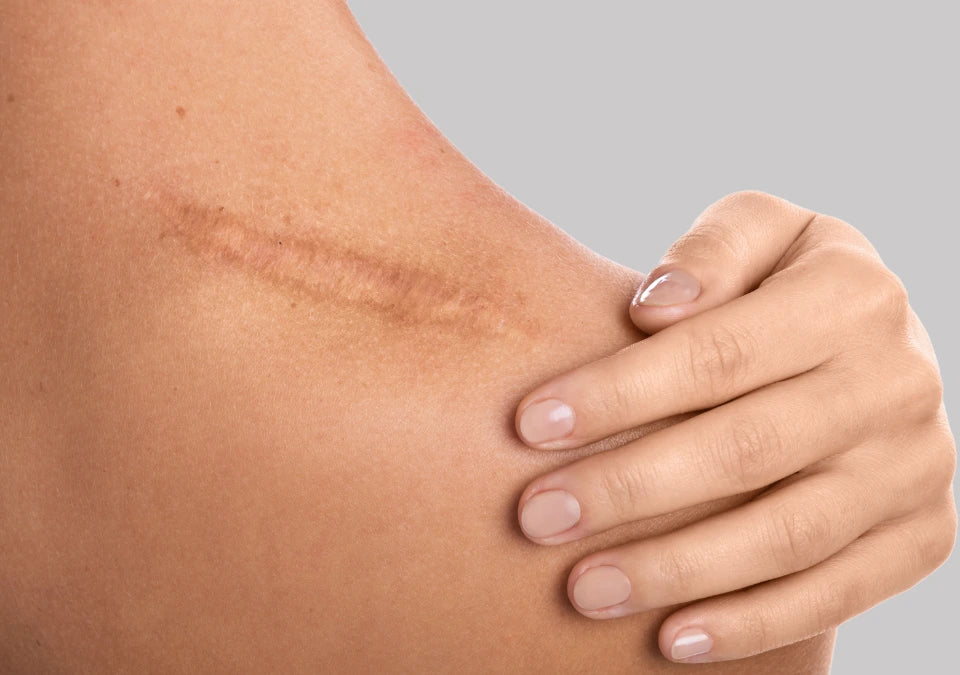 Woman applying skincare products to heal a scar, promoting skin repair and rejuvenation for a smoother and healthier complexion.