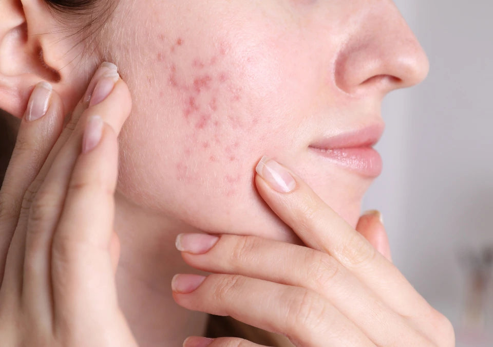 Woman using acne-safe, non-comedogenic skincare products to heal and repair her skin, promoting a clear and healthy complexion.